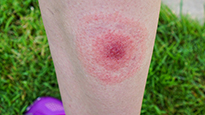 Lyme rash