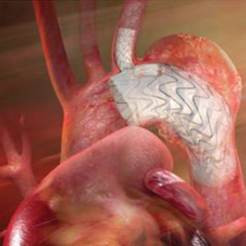 Thoracic Branch Endoprosthesis (TBE)