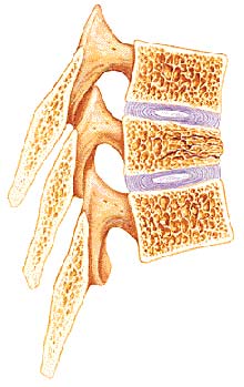 image of a kyphotic deformity