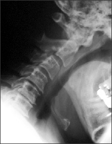 X-ray Cervical disc Degeneration