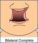 Medical illustration of a complete bilateral