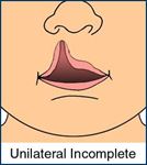 Medical illustration of an incompete unilateral