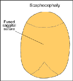 Medical illustration of scaphocephaly