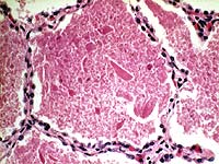 Medical scan of Alveolar Proteinosis