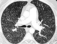CT scan showing multiple small nodules