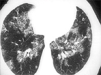 CT scan showing crazy paving