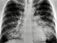 Chest X-Ray showing bilateral