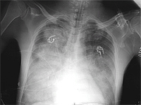 Medical scan of flash pulmonary edema