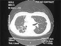 Medical scan of a mycobaterium avium-intracellular infection