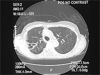 Medical scan of a mycobaterium avium-intracellular infection