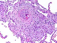 Medical scan of pulmonary talcosis