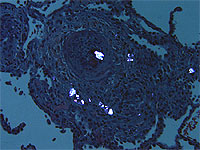 Medical scan of pulmonary talcosis