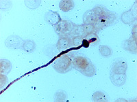 Medical scan of scedosporium