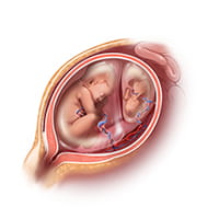 image of TTTS monochorionic twins sharing a single placenta