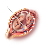 image of an intervention to treat TTTS