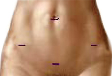 Medical illustration of typical incisions in the Robot-Assisted Laparoscopic Surgery