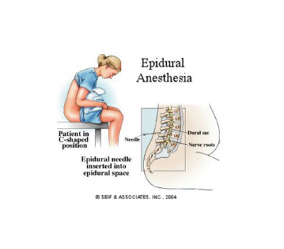 Epidural Anesthesia procedure