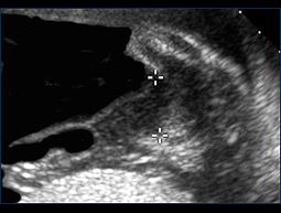 Ultrasound Image of amniocentesis amniodrain