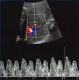 Scan of normal cardiac function with all blood flow forward